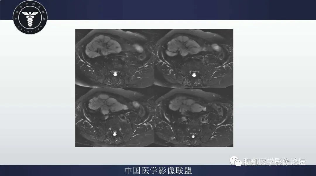 【病例】阑尾黏液腺癌1例CT及MR影像