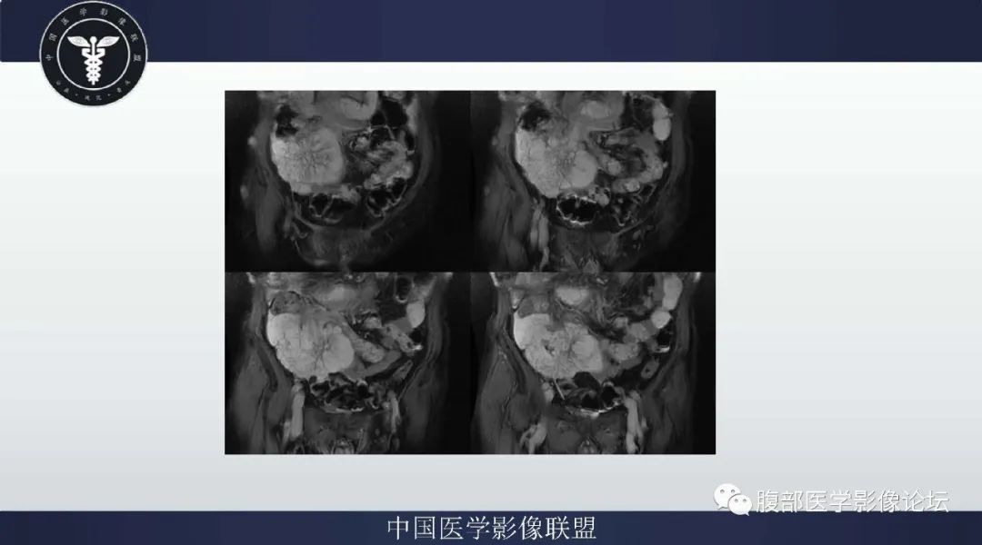 【病例】阑尾黏液腺癌1例CT及MR影像