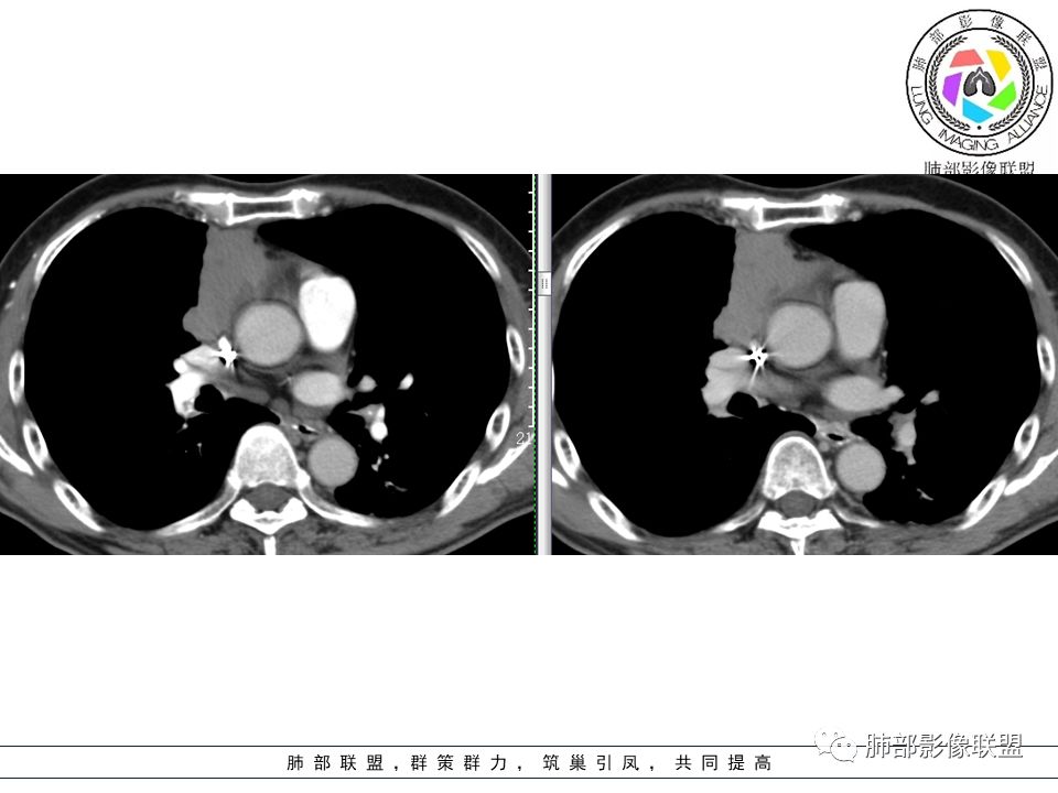 【病例】纵隔胸腺瘤1例CT影像讨论