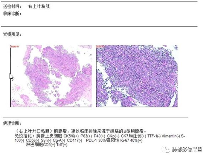 【病例】纵隔胸腺瘤1例CT影像讨论