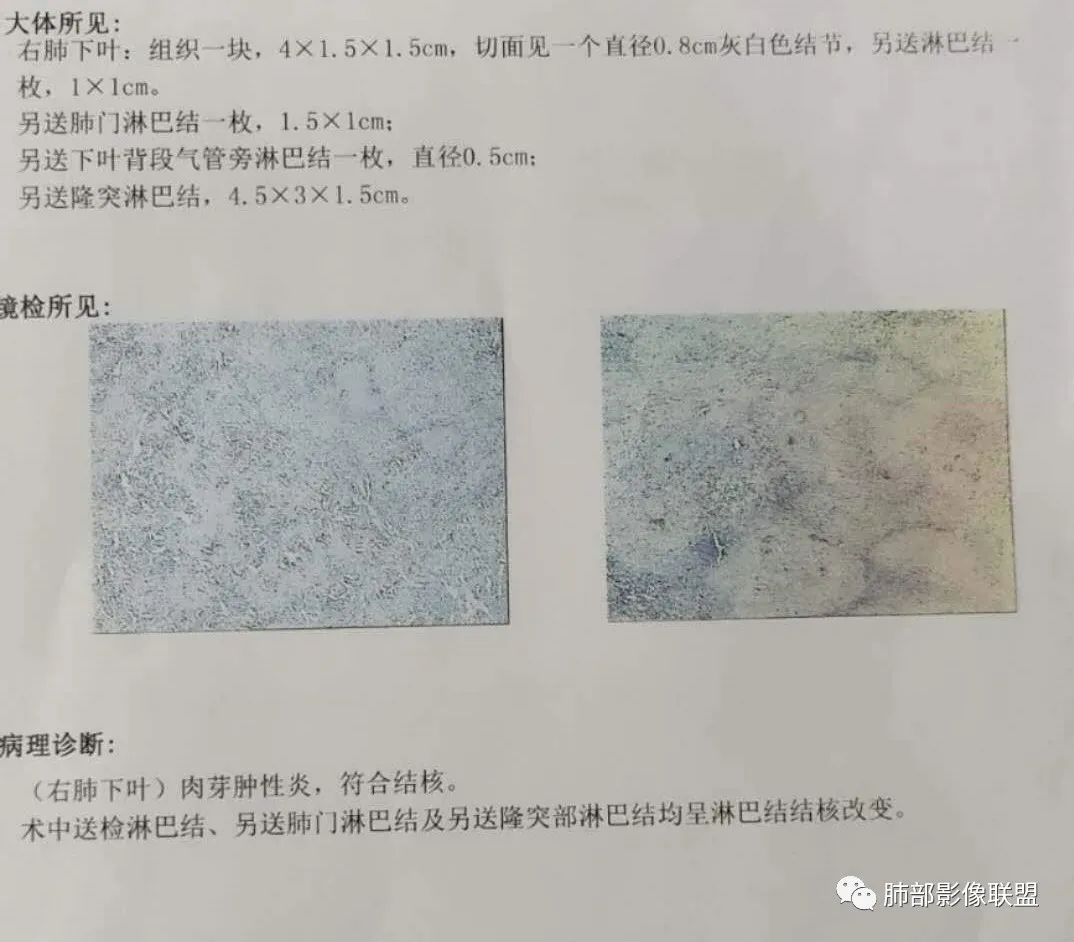 【病例】结核居然也能有晕征