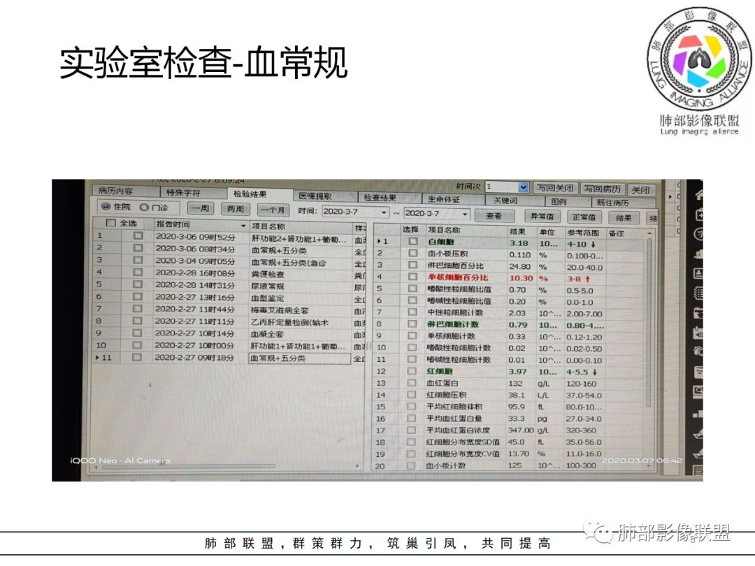 【病例】结核居然也能有晕征 【病例】结核居然也能有晕征