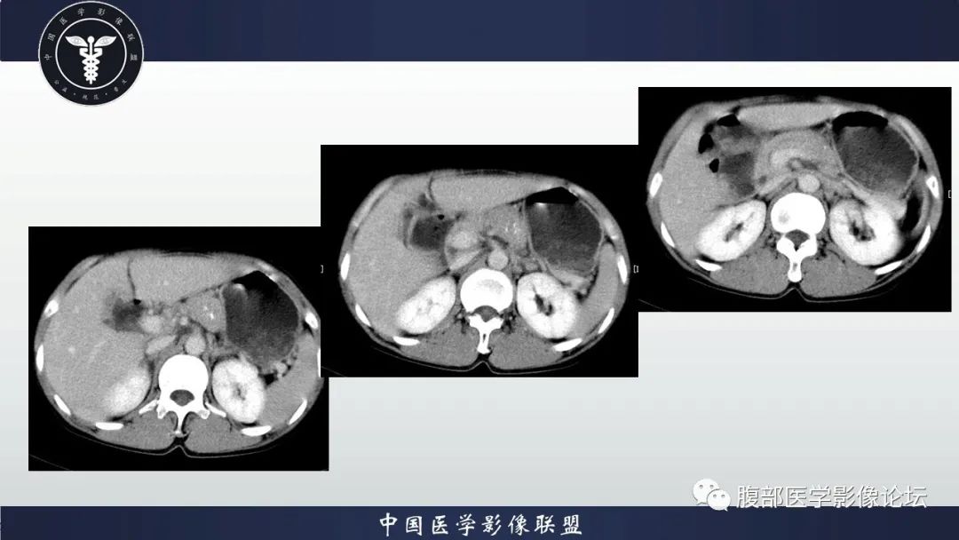 【病例】胰腺巨大淋巴结增生症(Castleman Disease)1例CT影像