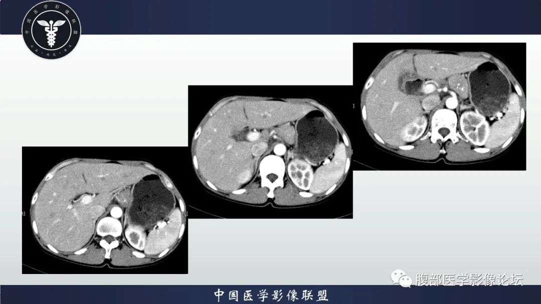 【病例】胰腺巨大淋巴结增生症(Castleman Disease)1例CT影像
