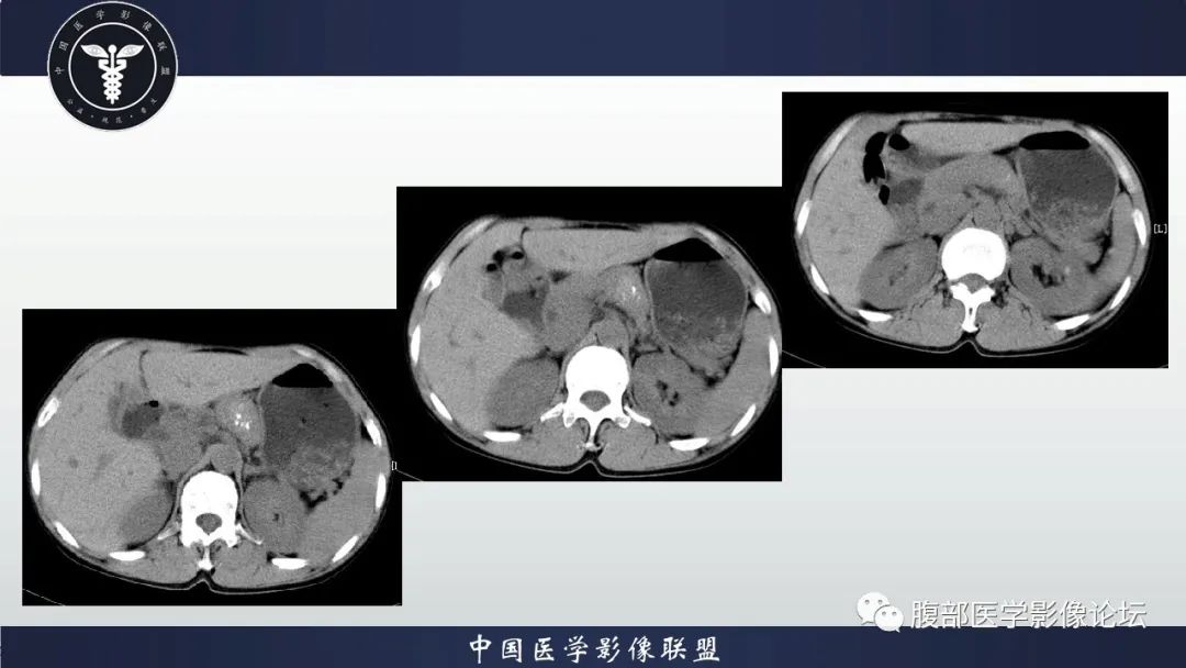 【病例】胰腺巨大淋巴结增生症(Castleman Disease)1例CT影像