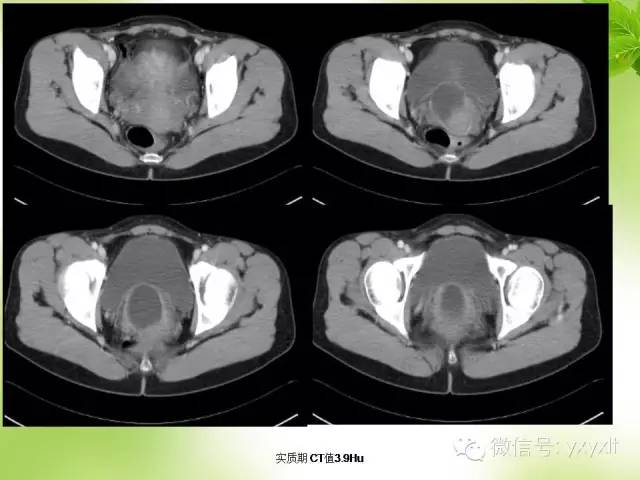 【病例】苗勒管囊肿1例CT影像表现