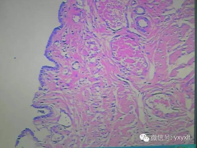 【病例】苗勒管囊肿1例CT影像表现