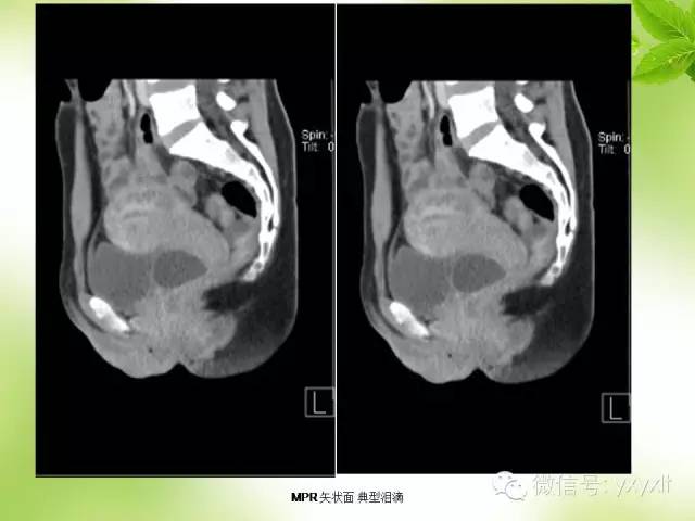 【病例】苗勒管囊肿1例CT影像表现