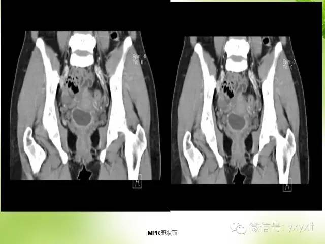 【病例】苗勒管囊肿1例CT影像表现