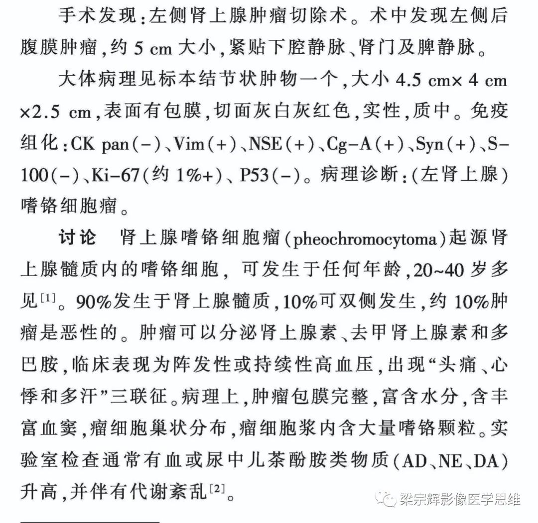 【病例】肾上腺嗜铬细胞瘤1例CT影像诊断思维