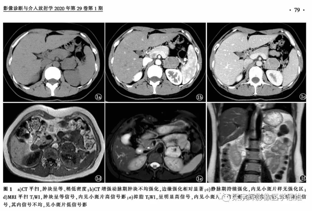 【病例】肾上腺嗜铬细胞瘤1例CT影像诊断思维