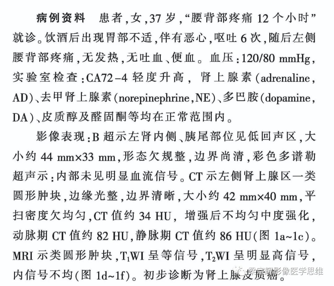【病例】肾上腺嗜铬细胞瘤1例CT影像诊断思维