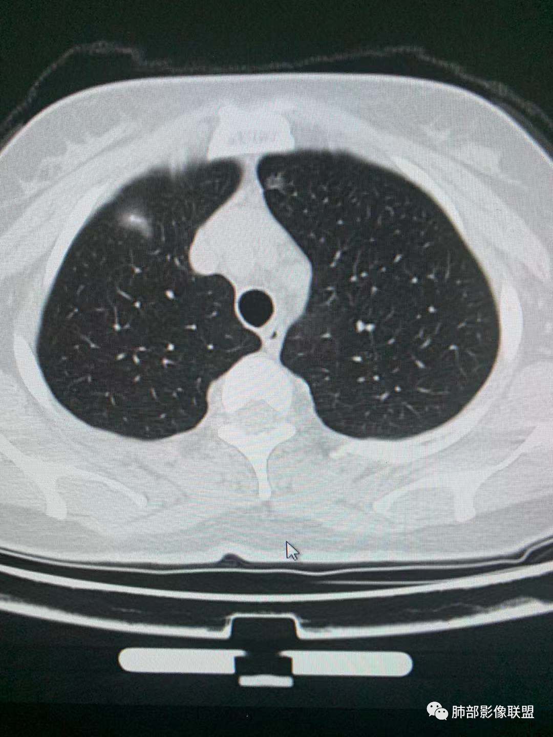 【病例】犹抱琵笆半遮面的肺腺癌