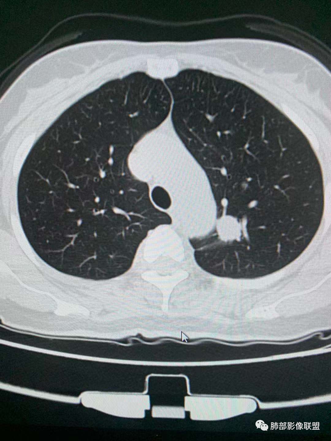 【病例】犹抱琵笆半遮面的肺腺癌
