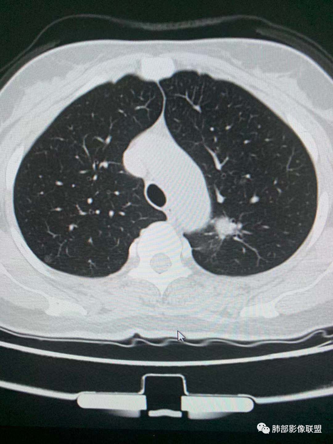 【病例】犹抱琵笆半遮面的肺腺癌