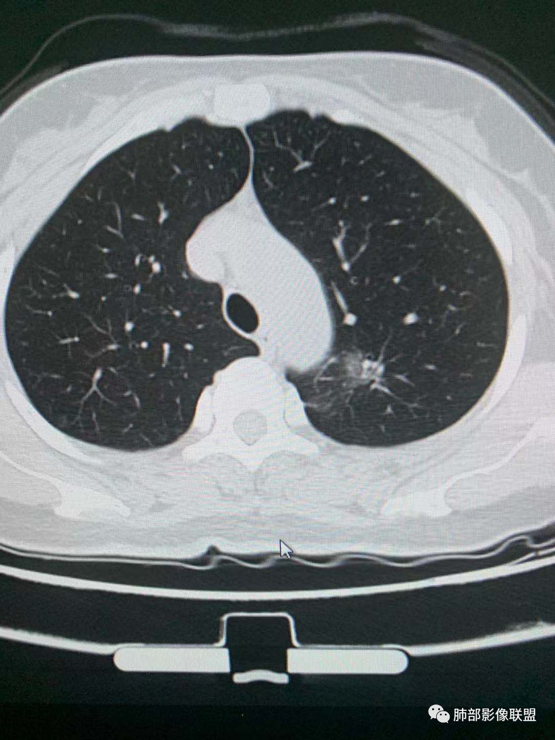 【病例】犹抱琵笆半遮面的肺腺癌