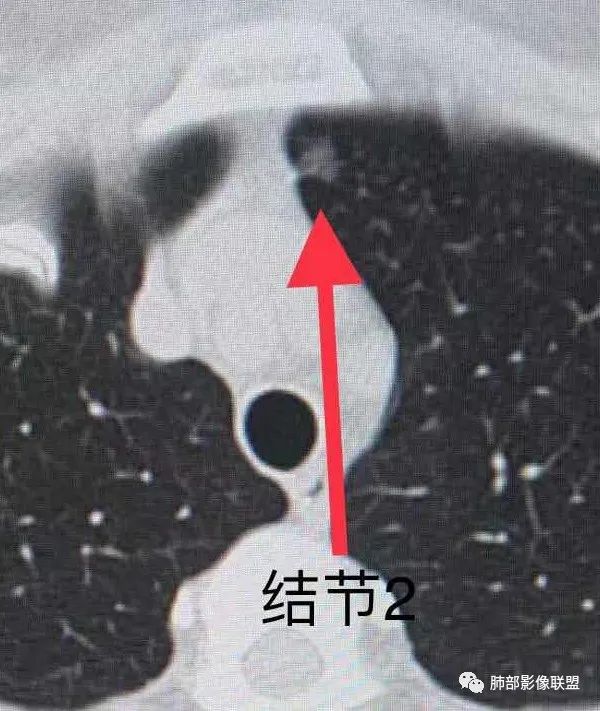 【病例】犹抱琵笆半遮面的肺腺癌