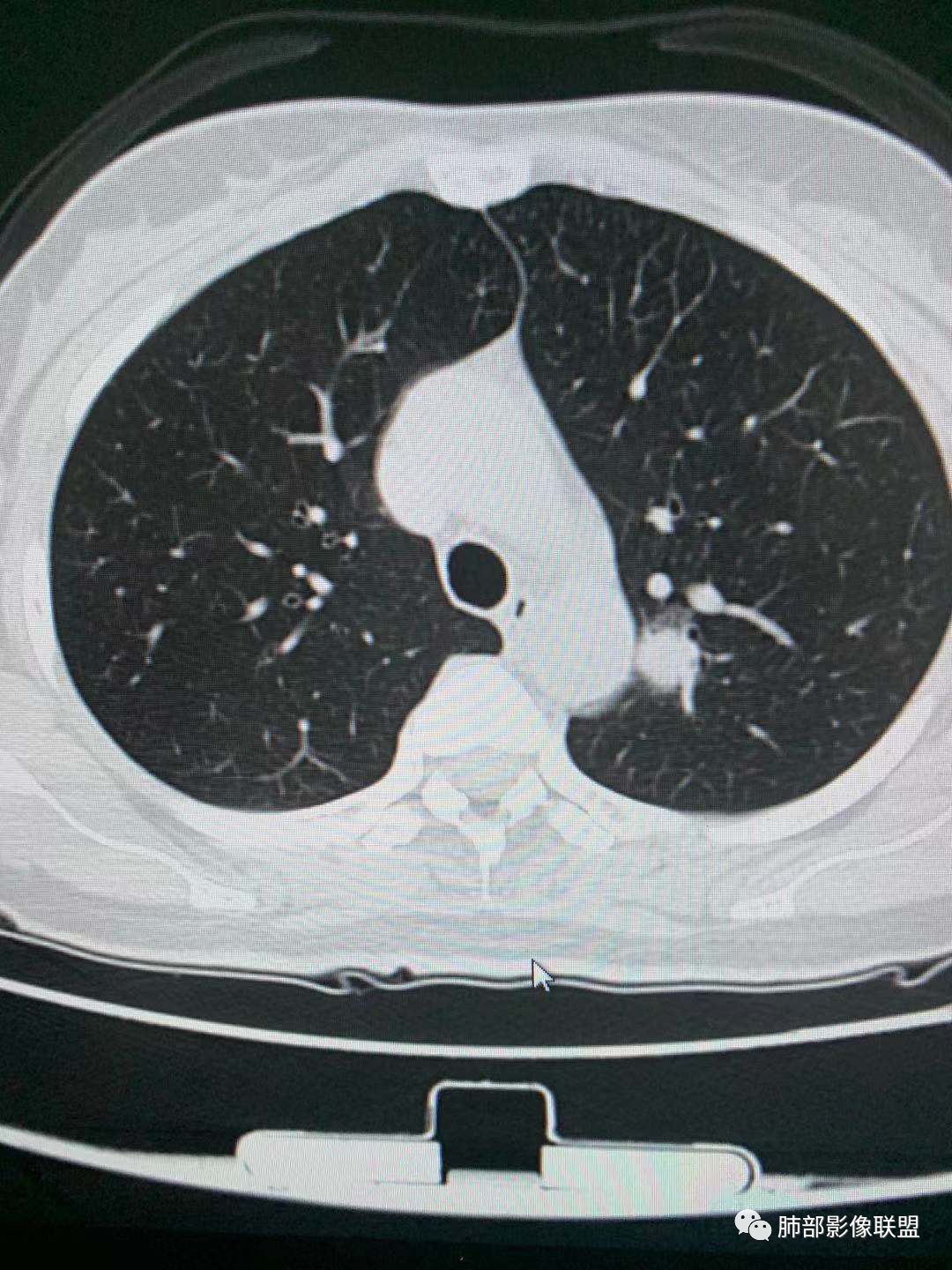 【病例】犹抱琵笆半遮面的肺腺癌