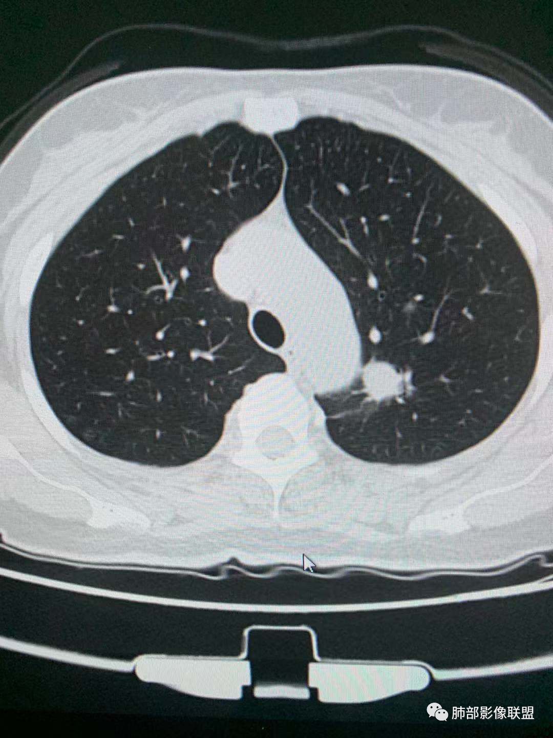【病例】犹抱琵笆半遮面的肺腺癌