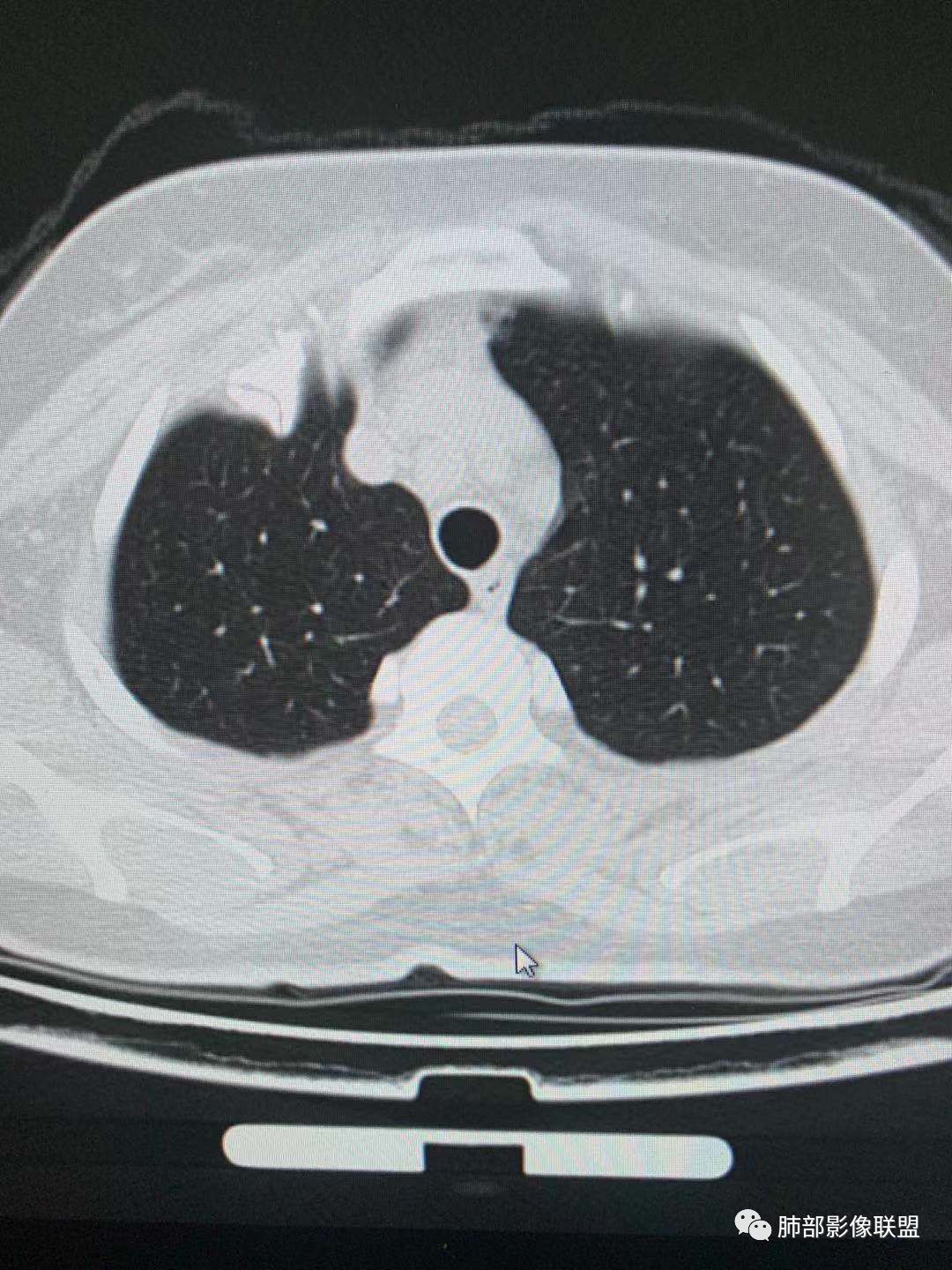 【病例】犹抱琵笆半遮面的肺腺癌