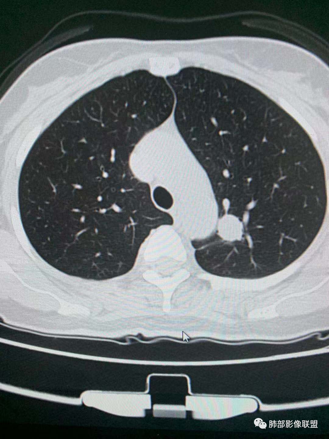 【病例】犹抱琵笆半遮面的肺腺癌
