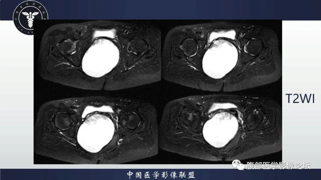 【病例】盆腔囊性成熟性畸胎瘤1例MR