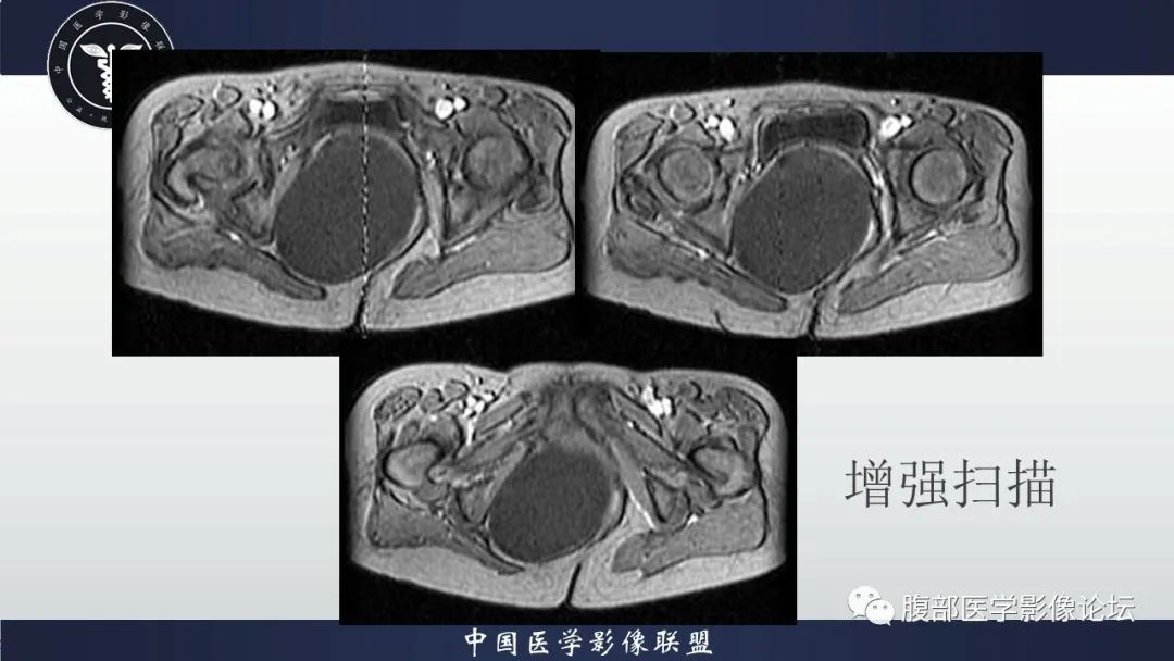 【病例】盆腔囊性成熟性畸胎瘤1例MR