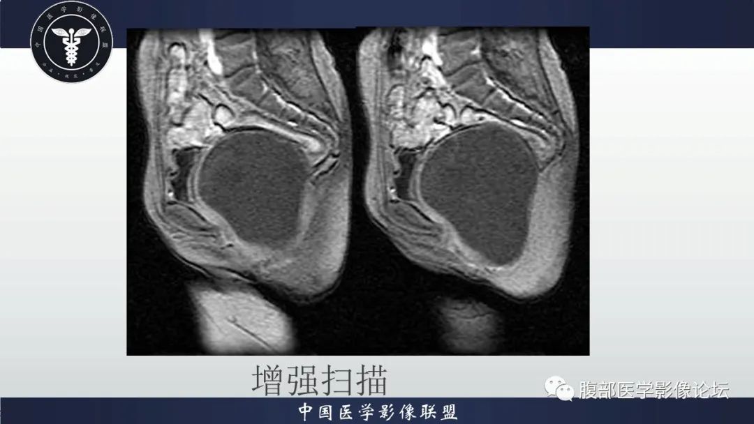 【病例】盆腔囊性成熟性畸胎瘤1例MR