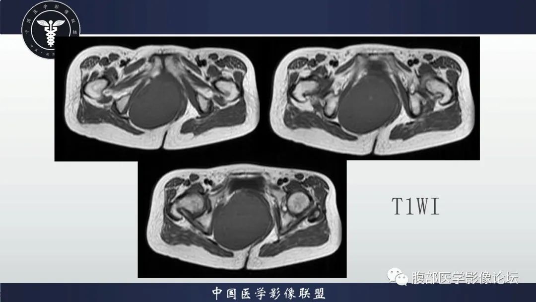 【病例】盆腔囊性成熟性畸胎瘤1例MR