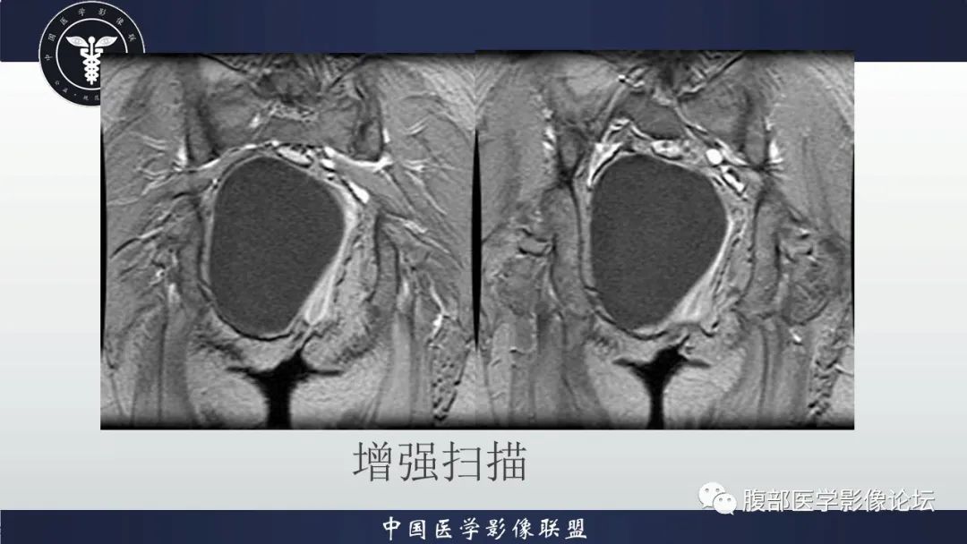 【病例】盆腔囊性成熟性畸胎瘤1例MR