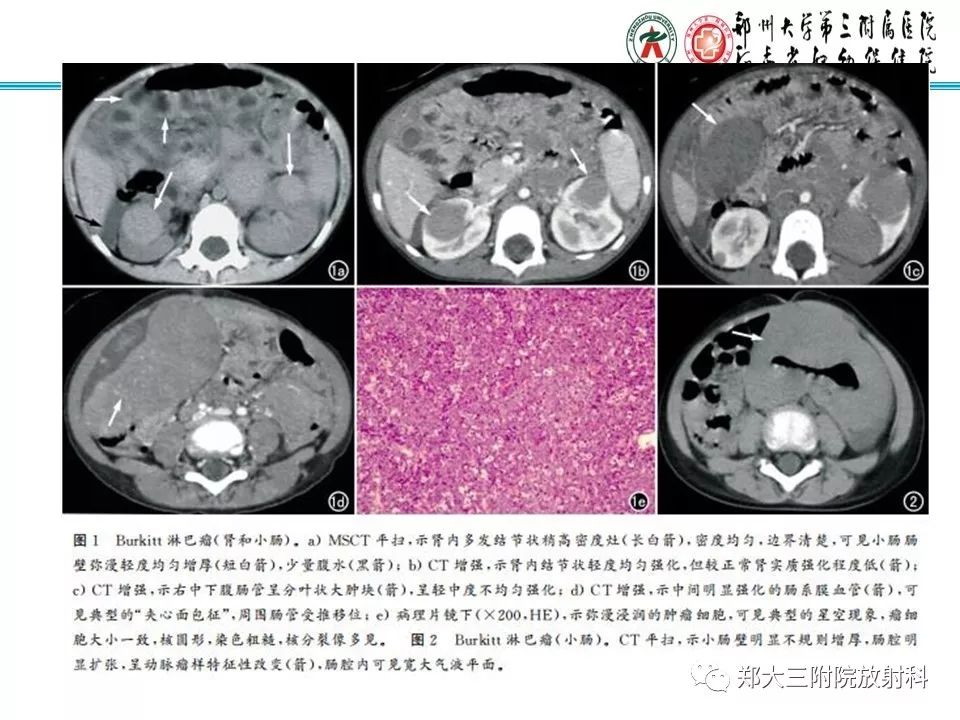 【PPT】小儿腹部伯基特Burkitt's淋巴瘤