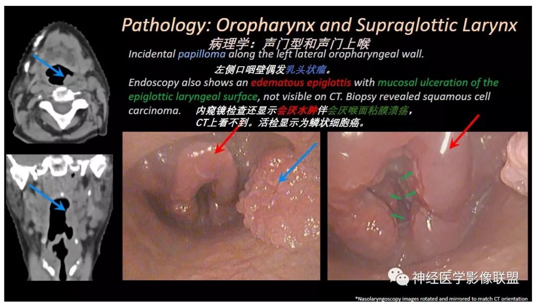 【PPT】内窥镜对照的喉部CT解剖学研究
