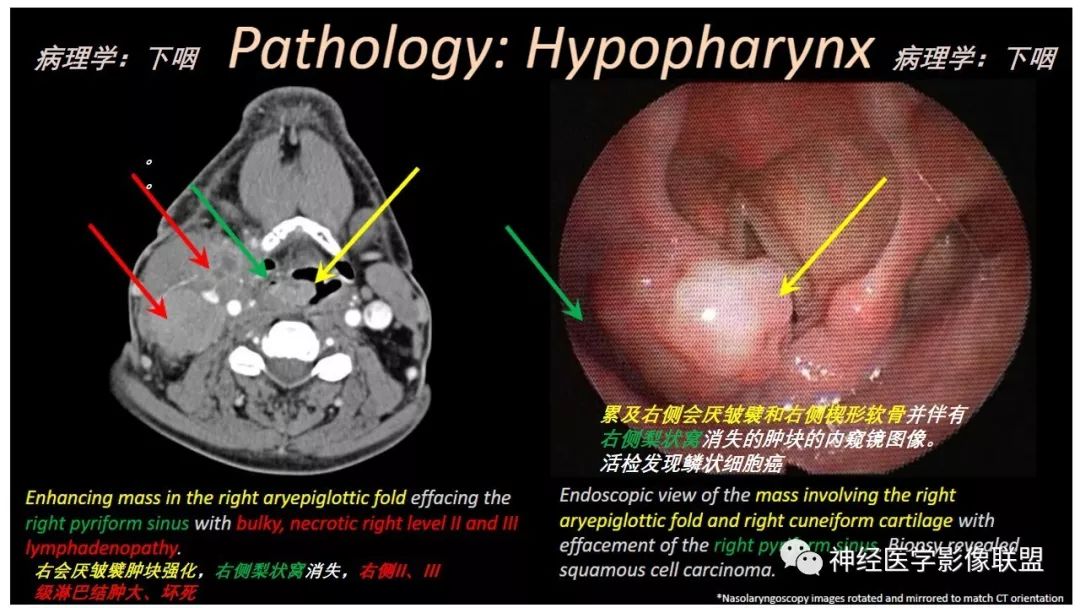 【PPT】内窥镜对照的喉部CT解剖学研究