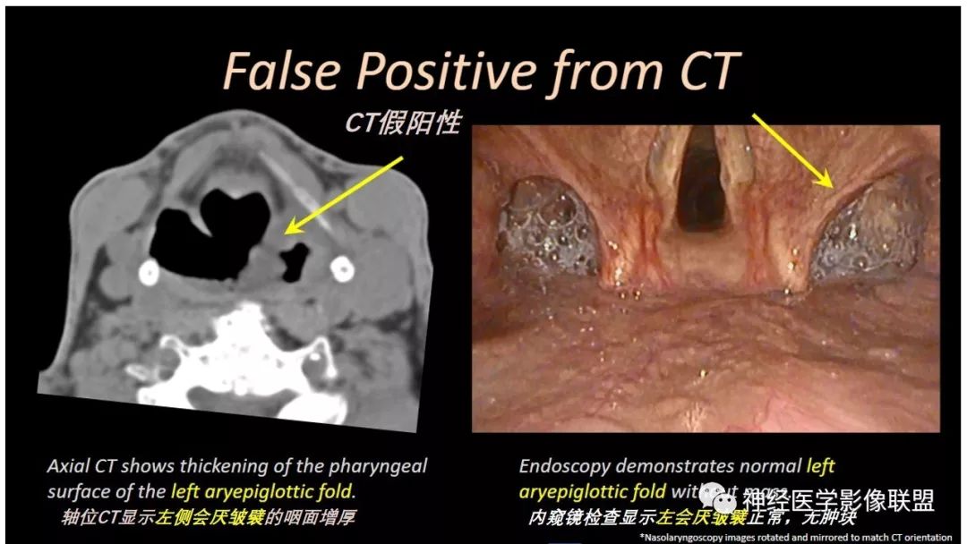 【PPT】内窥镜对照的喉部CT解剖学研究
