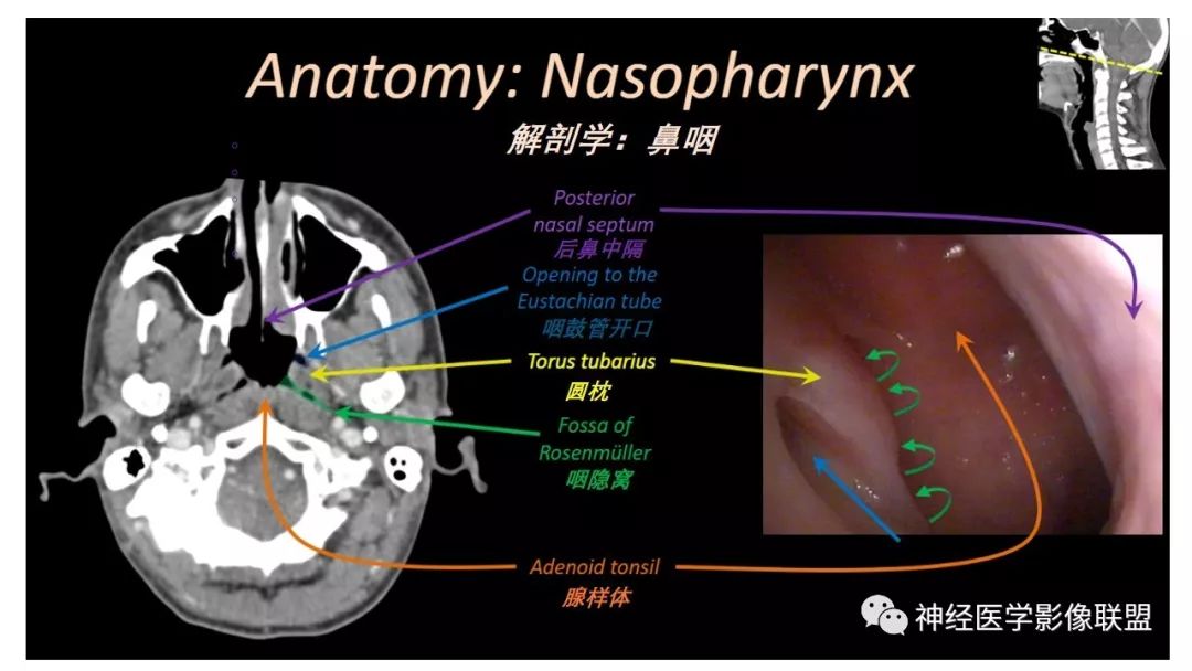 【PPT】内窥镜对照的喉部CT解剖学研究