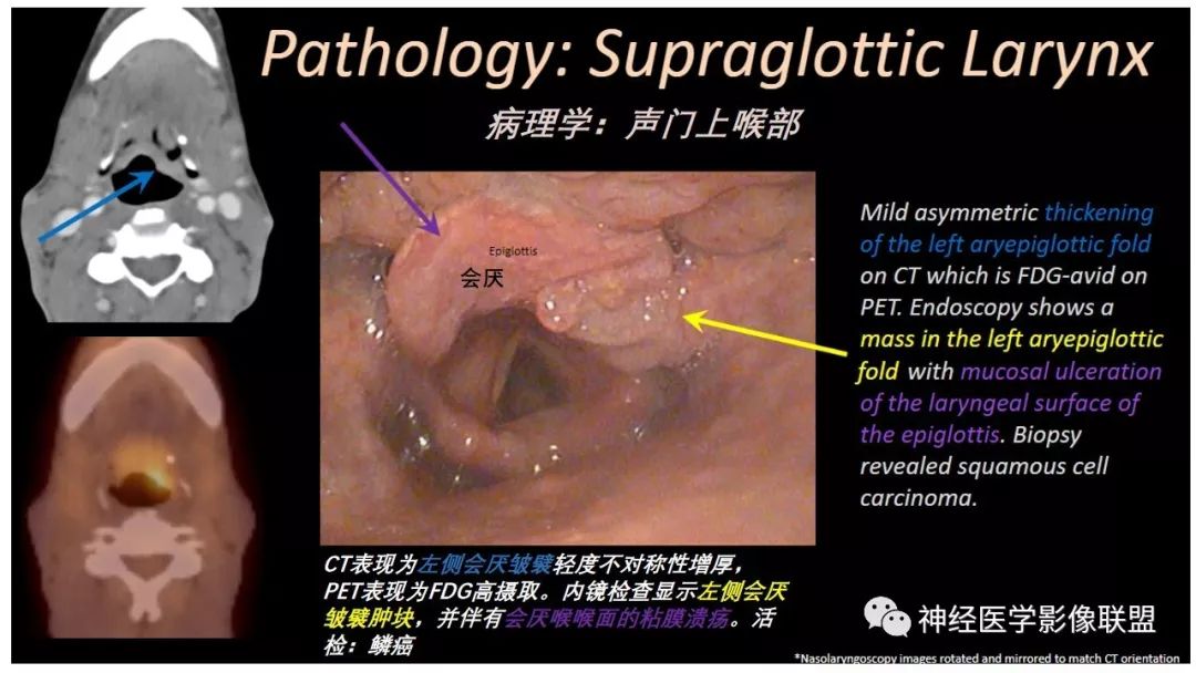 【PPT】内窥镜对照的喉部CT解剖学研究