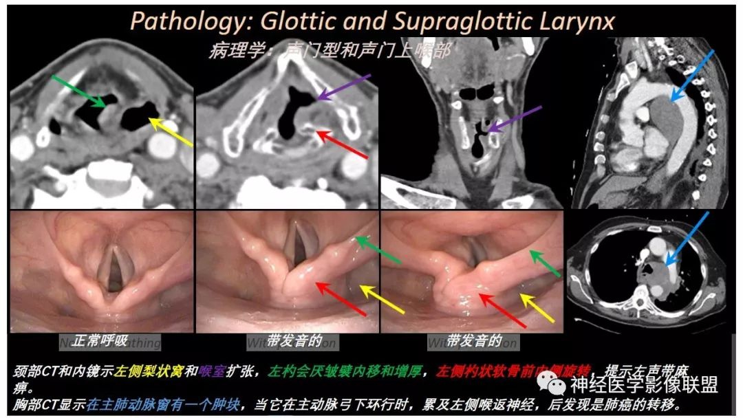 【PPT】内窥镜对照的喉部CT解剖学研究