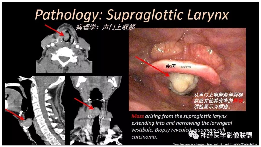 【PPT】内窥镜对照的喉部CT解剖学研究