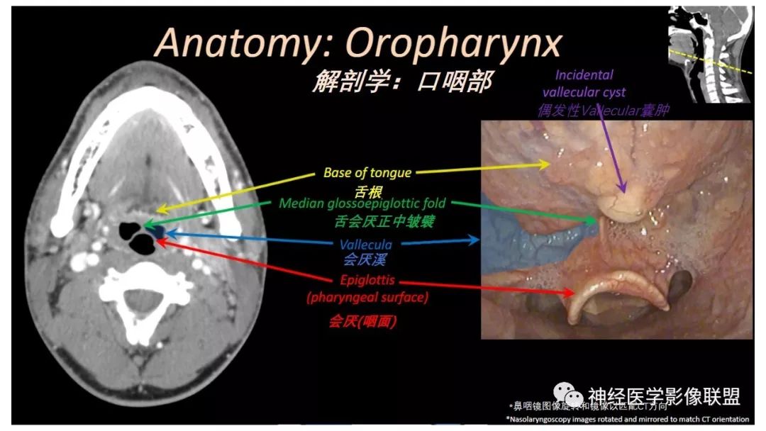 【PPT】内窥镜对照的喉部CT解剖学研究