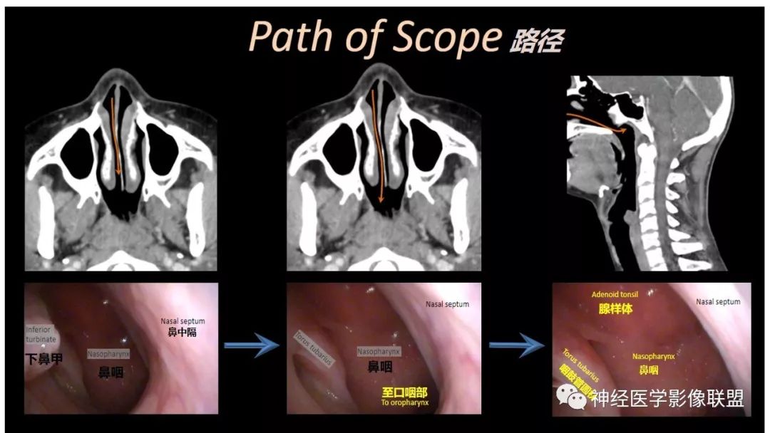 【PPT】内窥镜对照的喉部CT解剖学研究