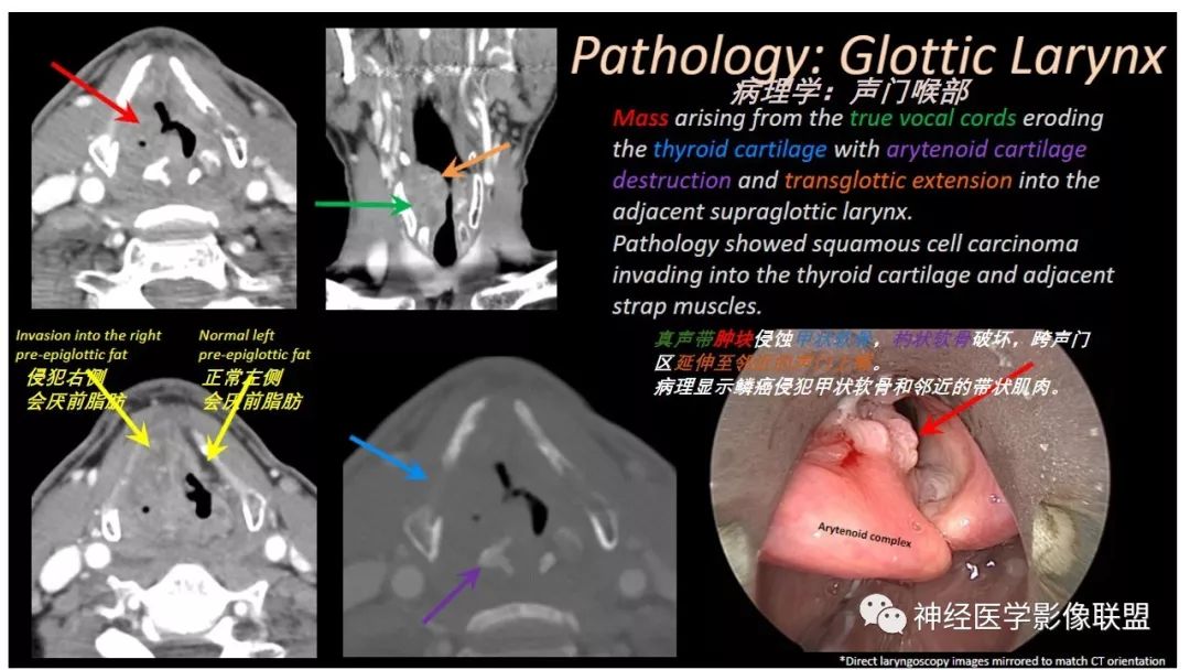 【PPT】内窥镜对照的喉部CT解剖学研究