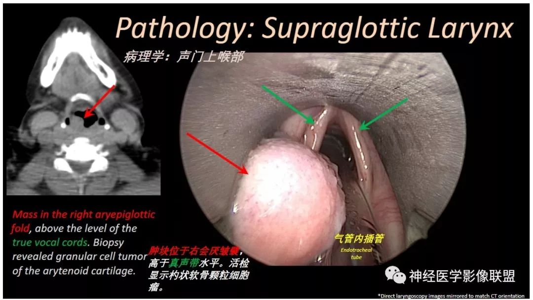 【PPT】内窥镜对照的喉部CT解剖学研究
