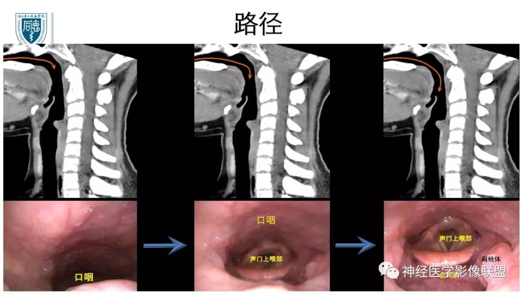 【PPT】内窥镜对照的喉部CT解剖学研究
