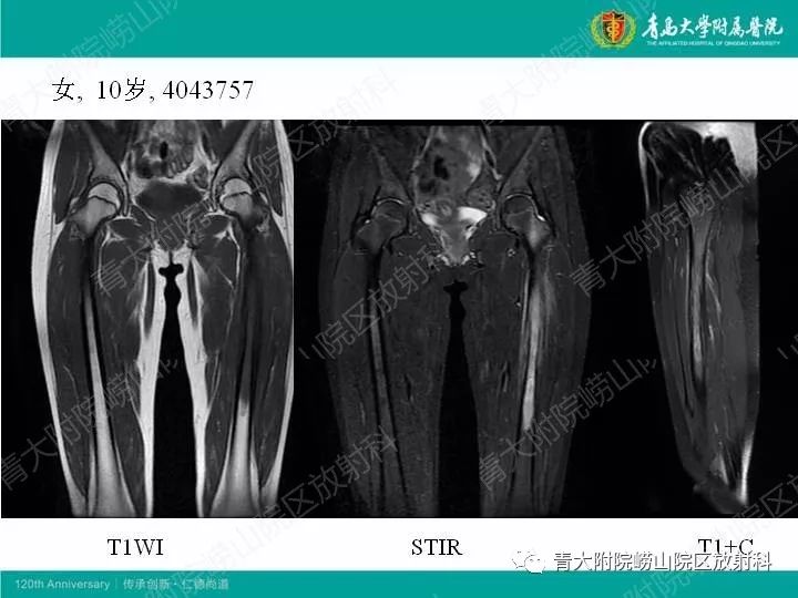 【病例】股骨尤文肉瘤1例CT及MR影像