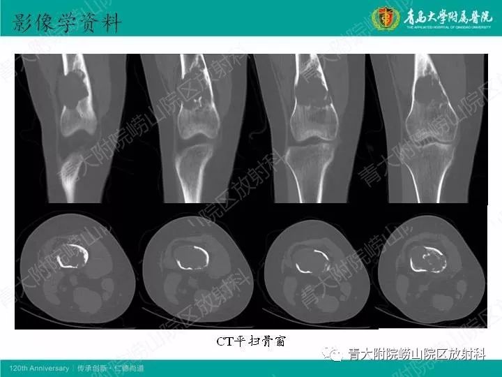【病例】股骨尤文肉瘤1例CT及MR影像