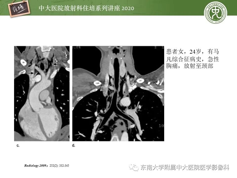 【PPT】胸痛三联CTA的临床应用