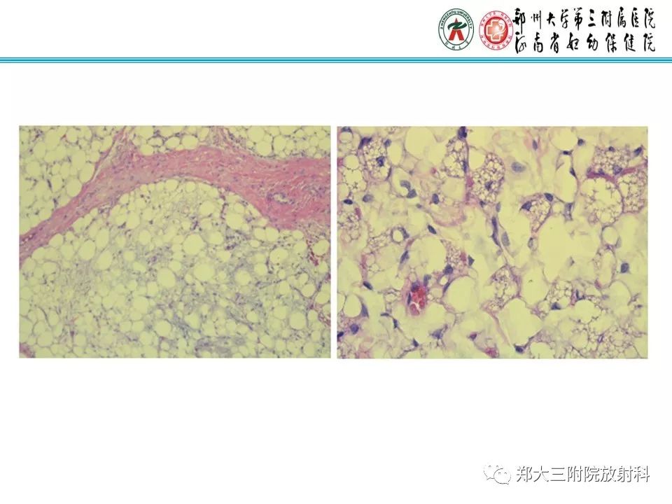 【病例】儿童颈部脂肪母细胞瘤1例影像诊断 【病例】儿童颈部脂肪母细胞瘤1例影像诊断