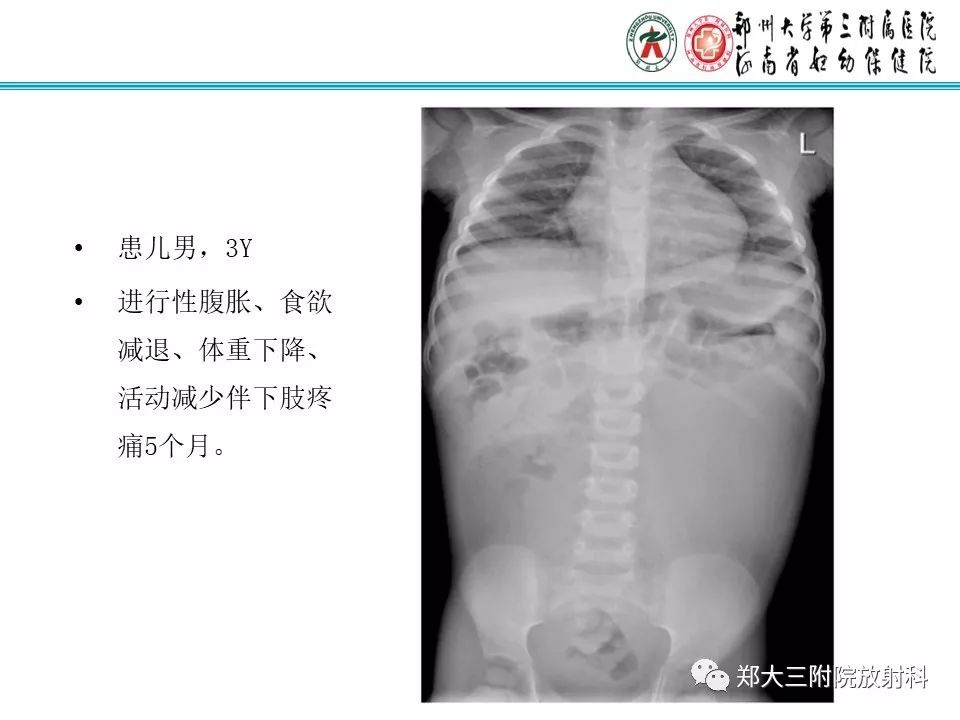【病例】儿童颈部脂肪母细胞瘤1例影像诊断 【病例】儿童颈部脂肪母细胞瘤1例影像诊断