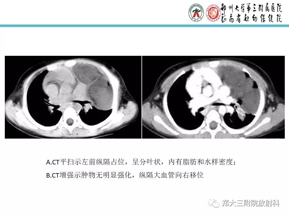 【病例】儿童颈部脂肪母细胞瘤1例影像诊断 【病例】儿童颈部脂肪母细胞瘤1例影像诊断
