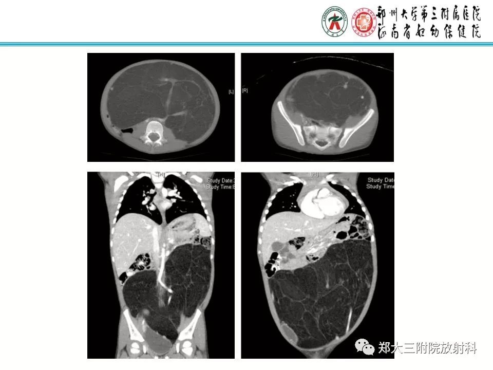 【病例】儿童颈部脂肪母细胞瘤1例影像诊断 【病例】儿童颈部脂肪母细胞瘤1例影像诊断